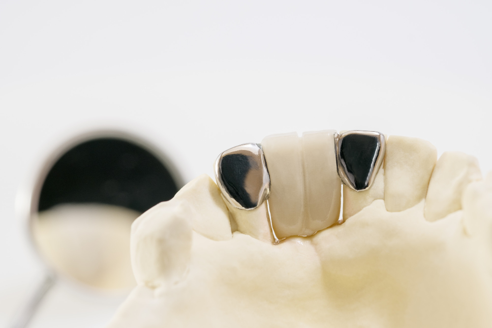 Цирконий или металлокерамика: какая коронка лучше?