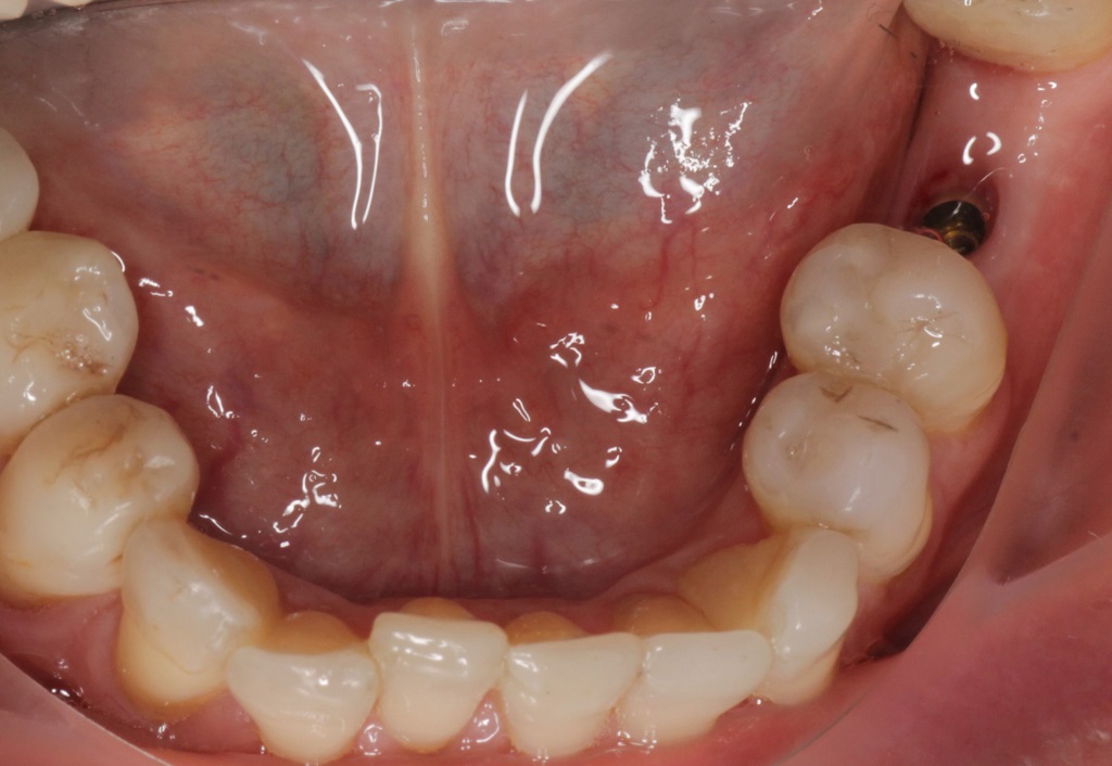 Установка имплантата