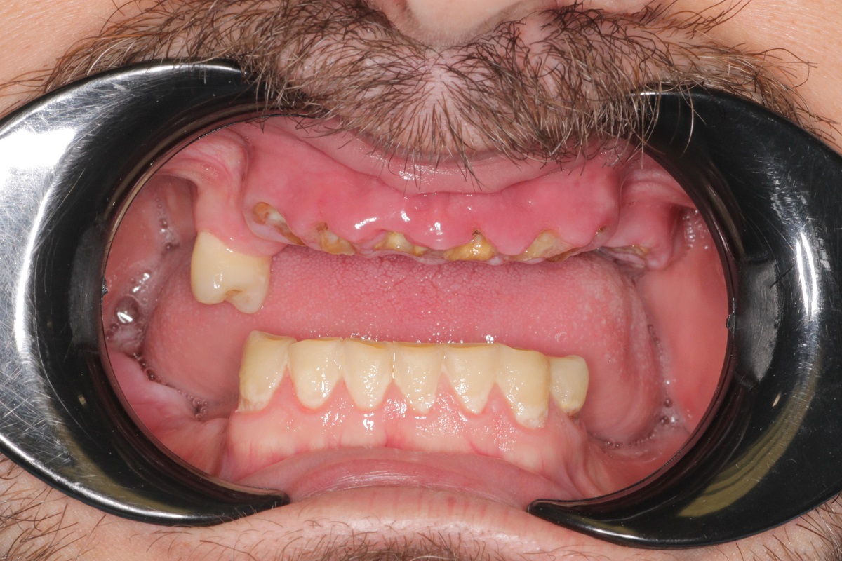 Восстановление верхней челюсти по системе All-on-6