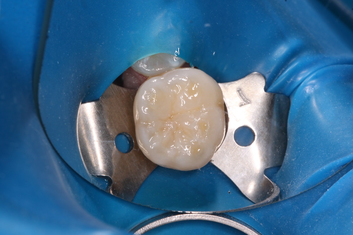 Лечение кариеса