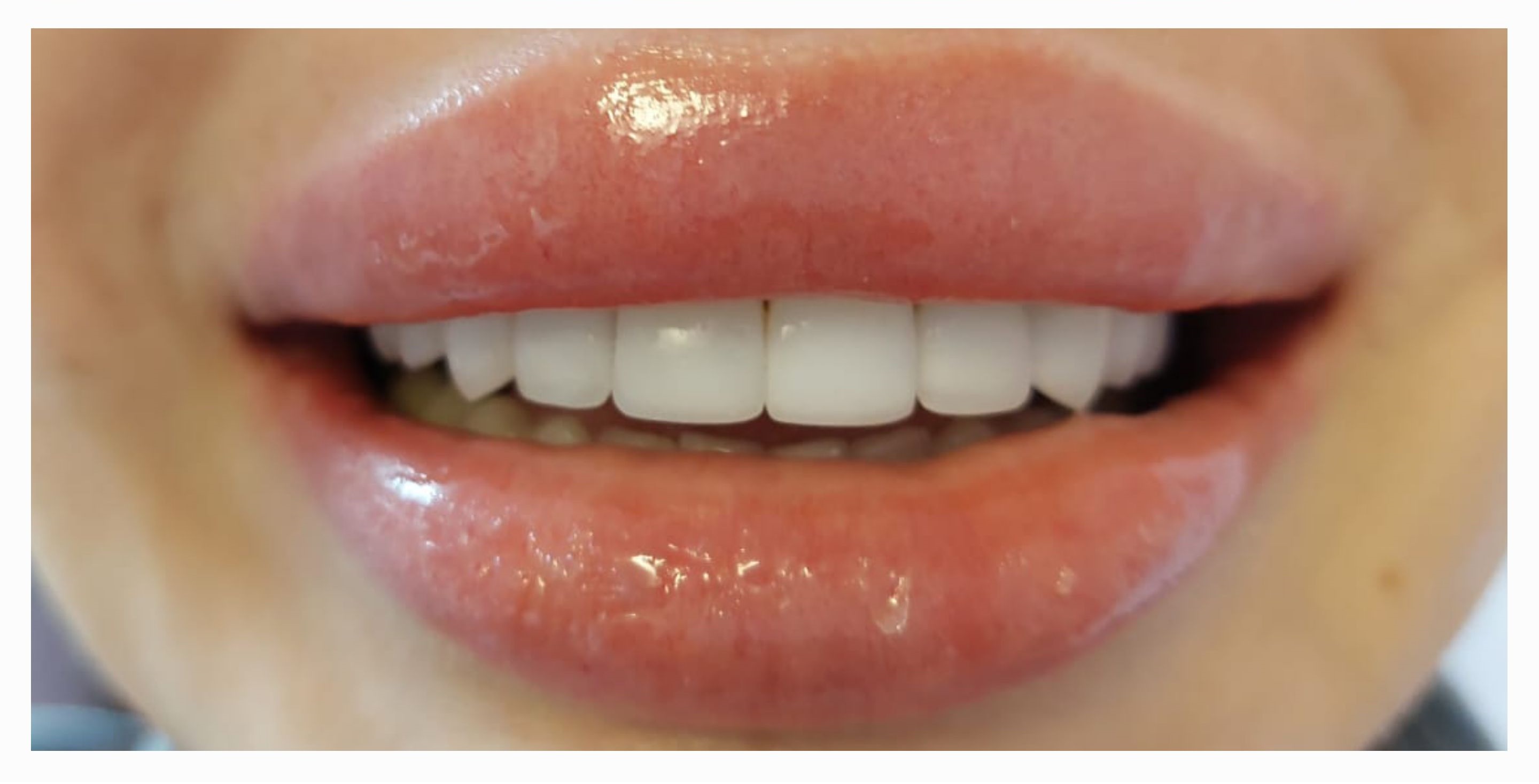 Композитные виниры