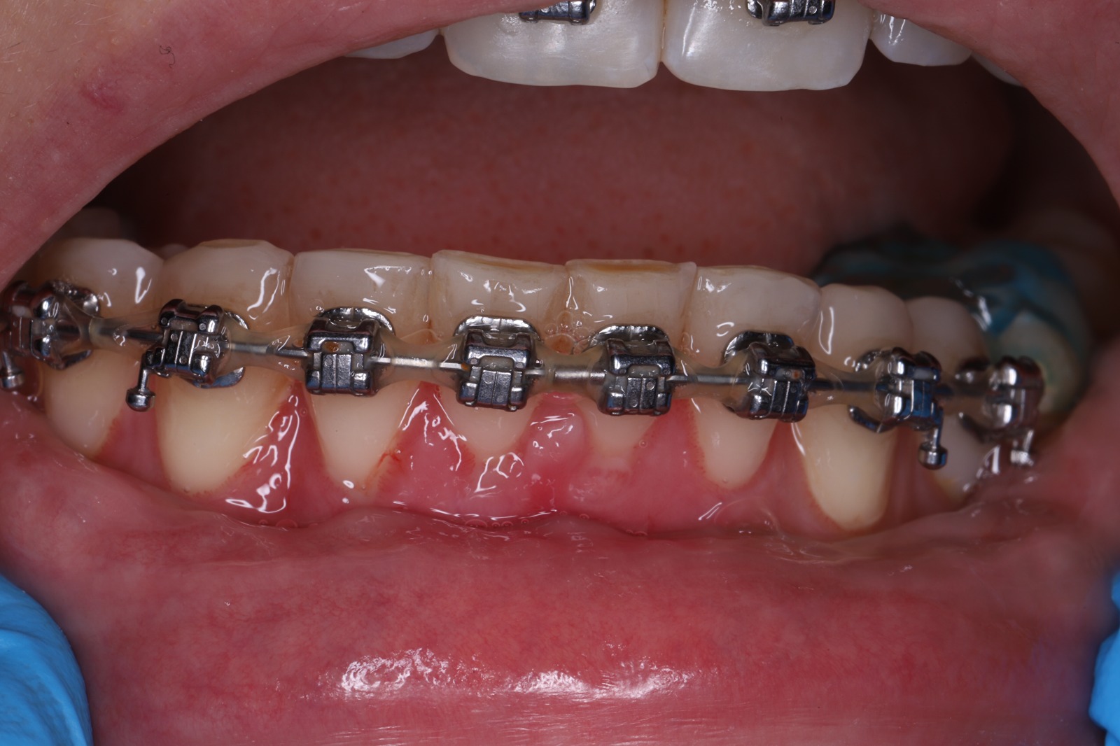 Закрытие рецессий