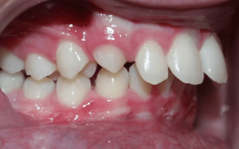 Как исправить дистальный прикус