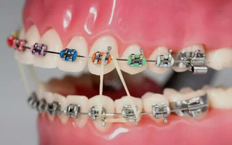 Сколько носят брекеты взрослые и дети