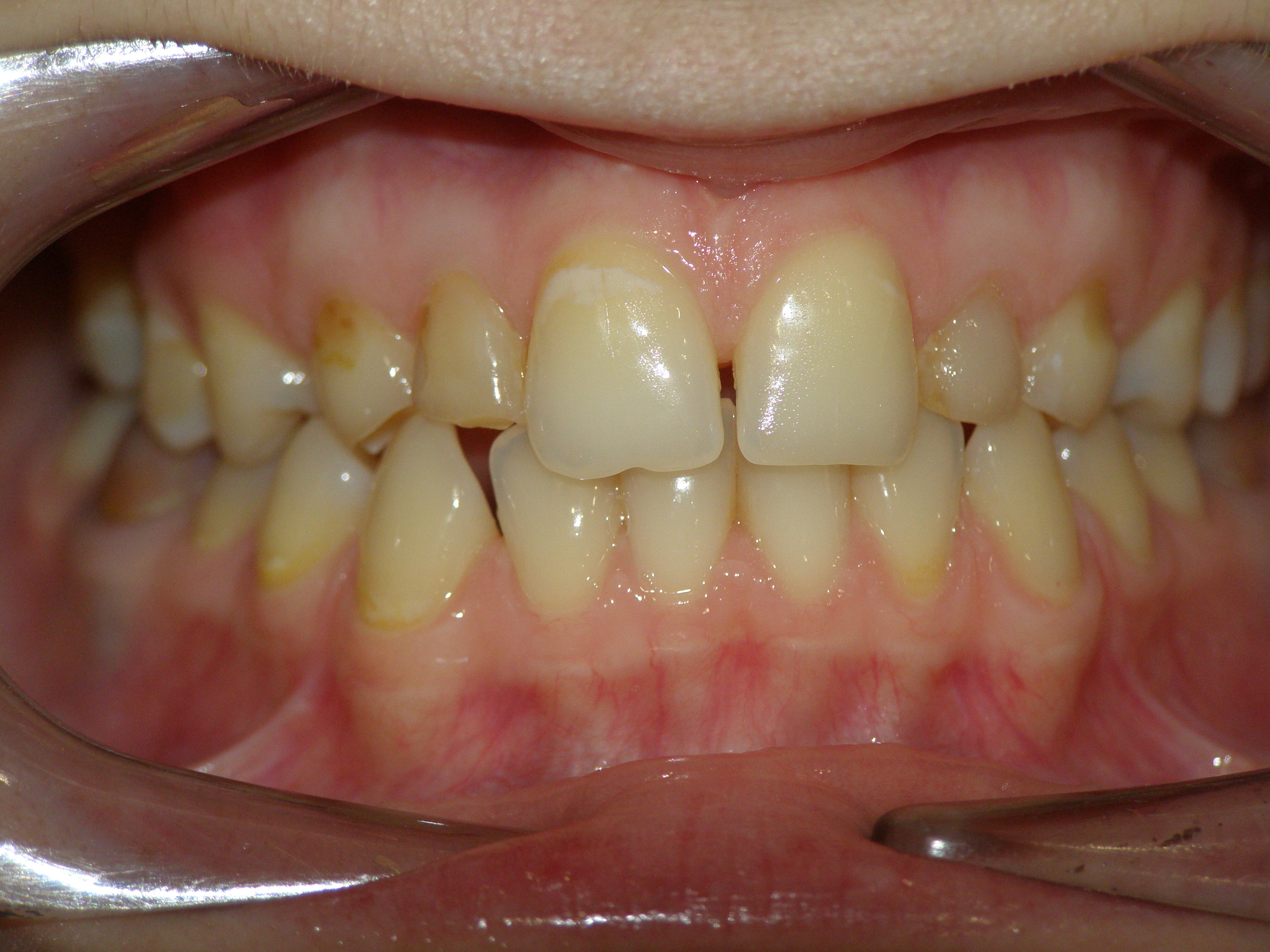 Исправление прикуса брекетами