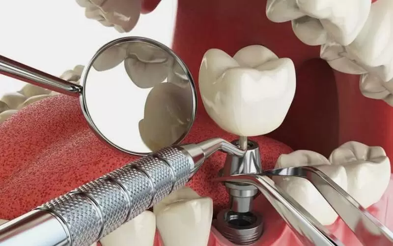 Как ставят импланты зубов