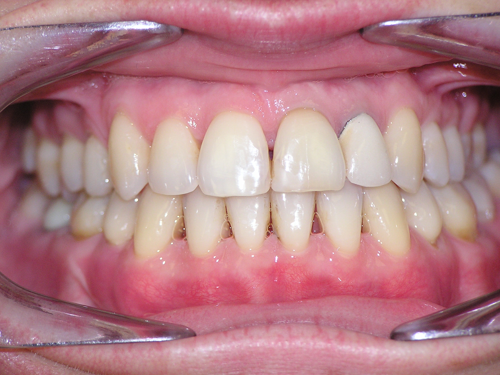 Исправление прикуса брекетами