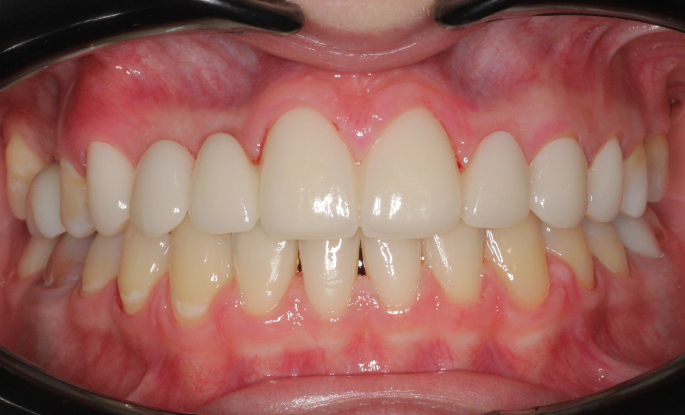 Исправление прикуса брекетами