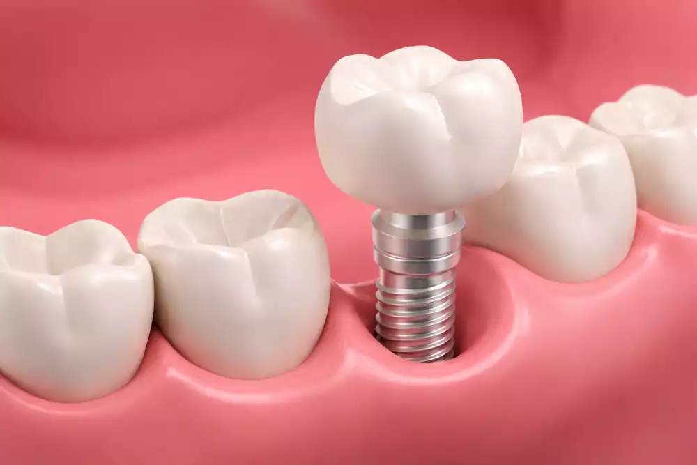 Сколько времени занимает имплантация зуба: этапы и реальные сроки