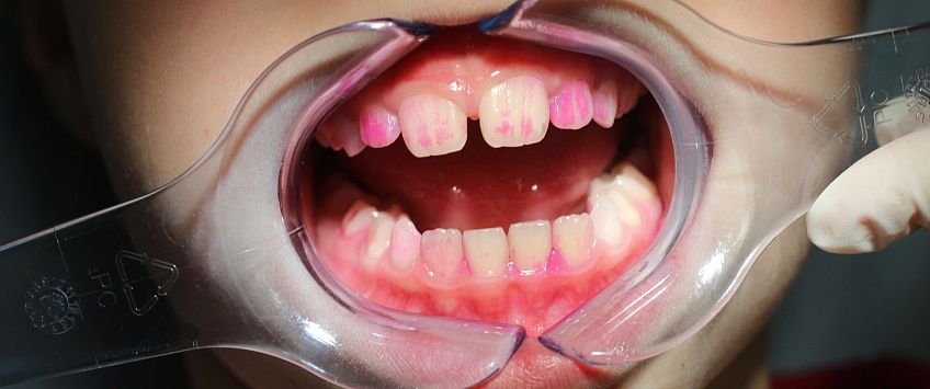 Молочный зуб стал розовым после лечения thumbnail