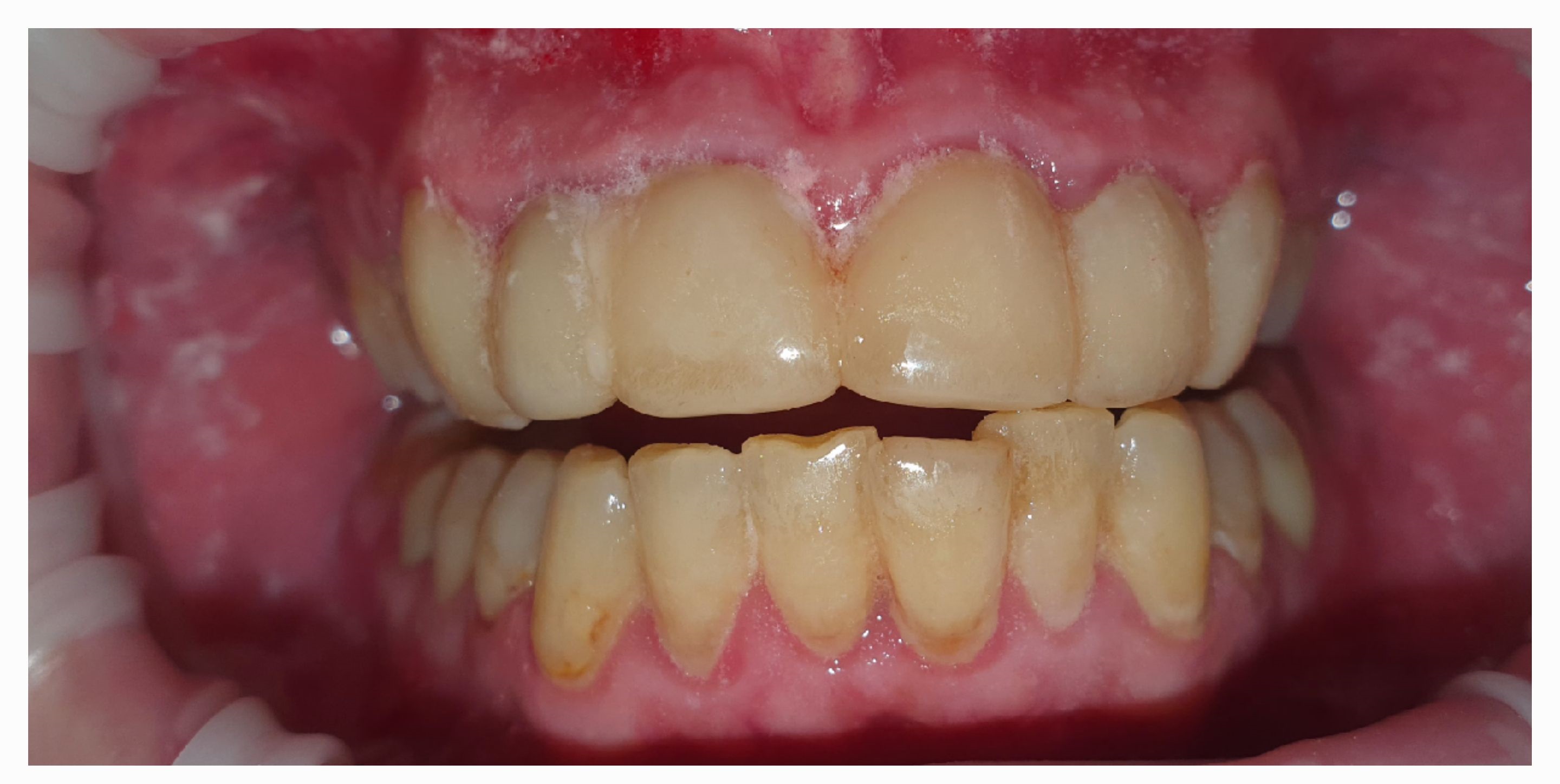 Композитные виниры