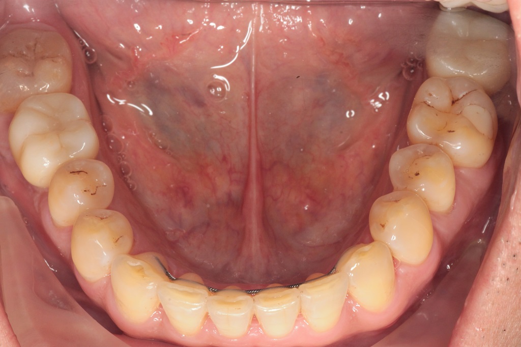 Установка имплантата