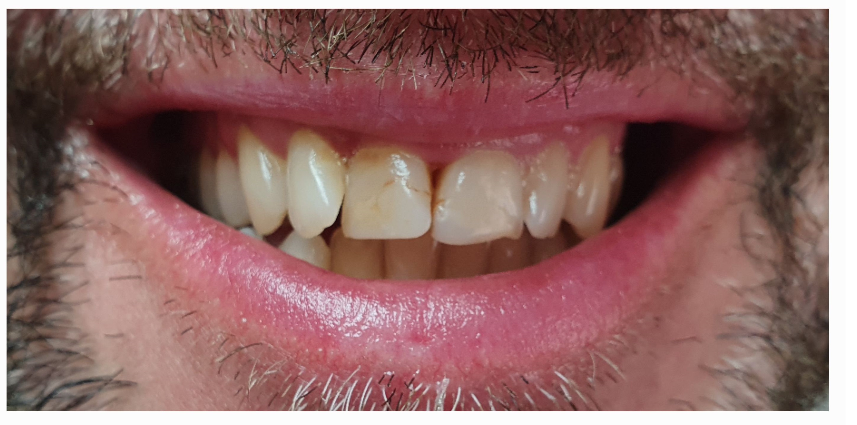 Композитные виниры