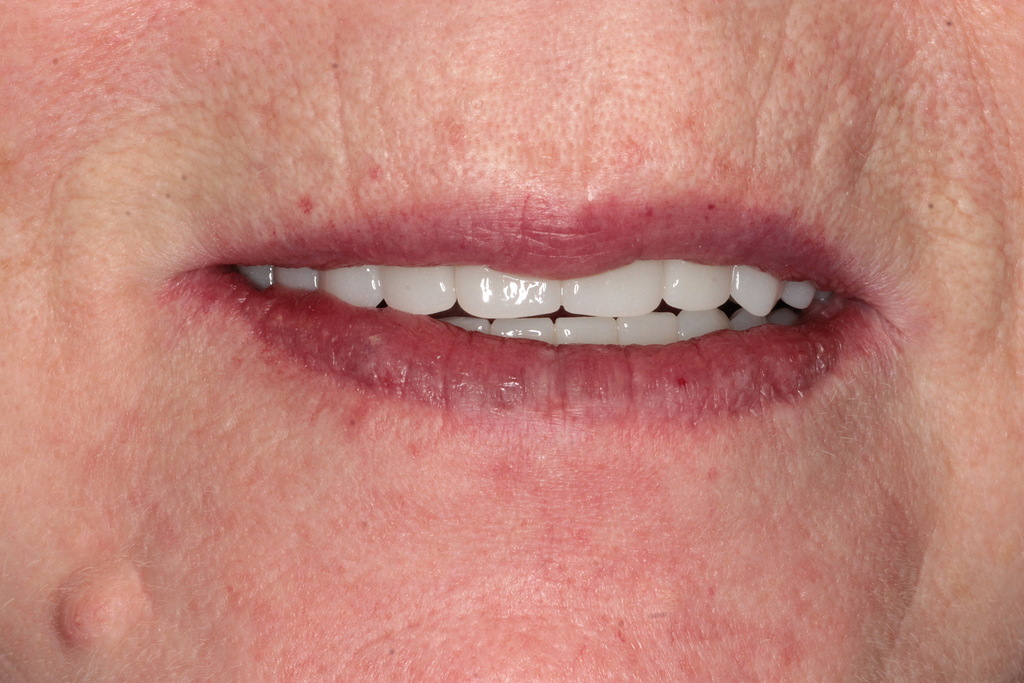 Восстановление зубов ALL-ON-6