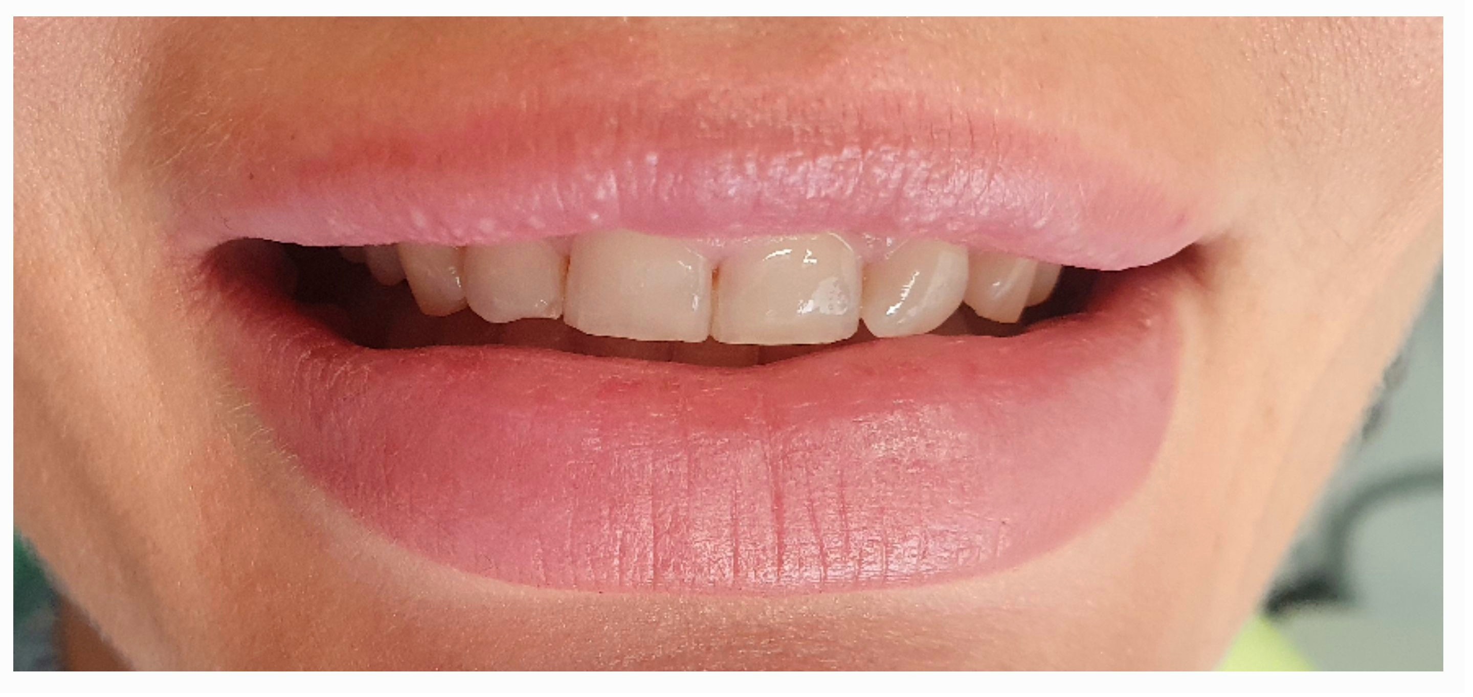 Композитные виниры