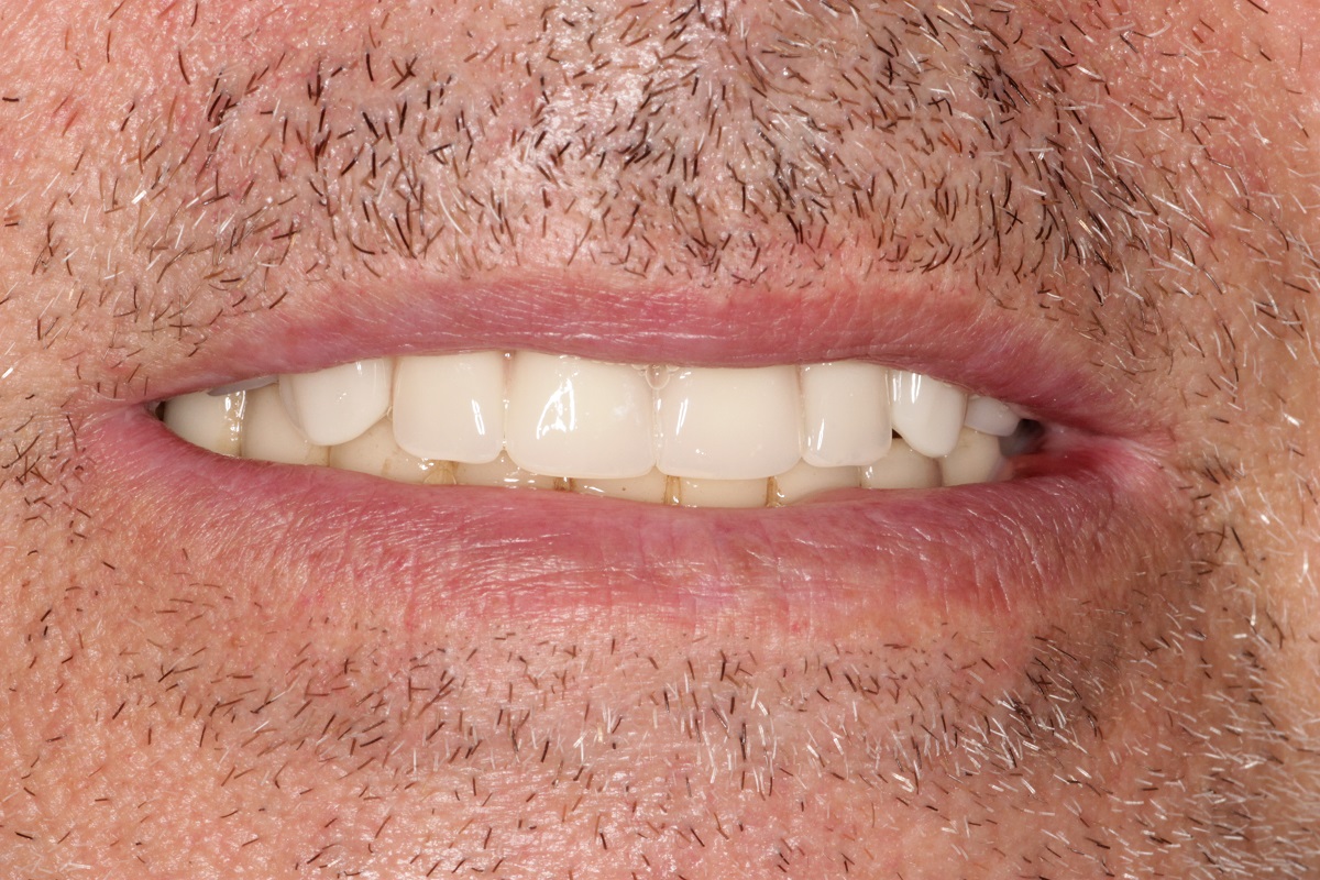 Восстановление верхней и нижней челюсти по системе All-on-6