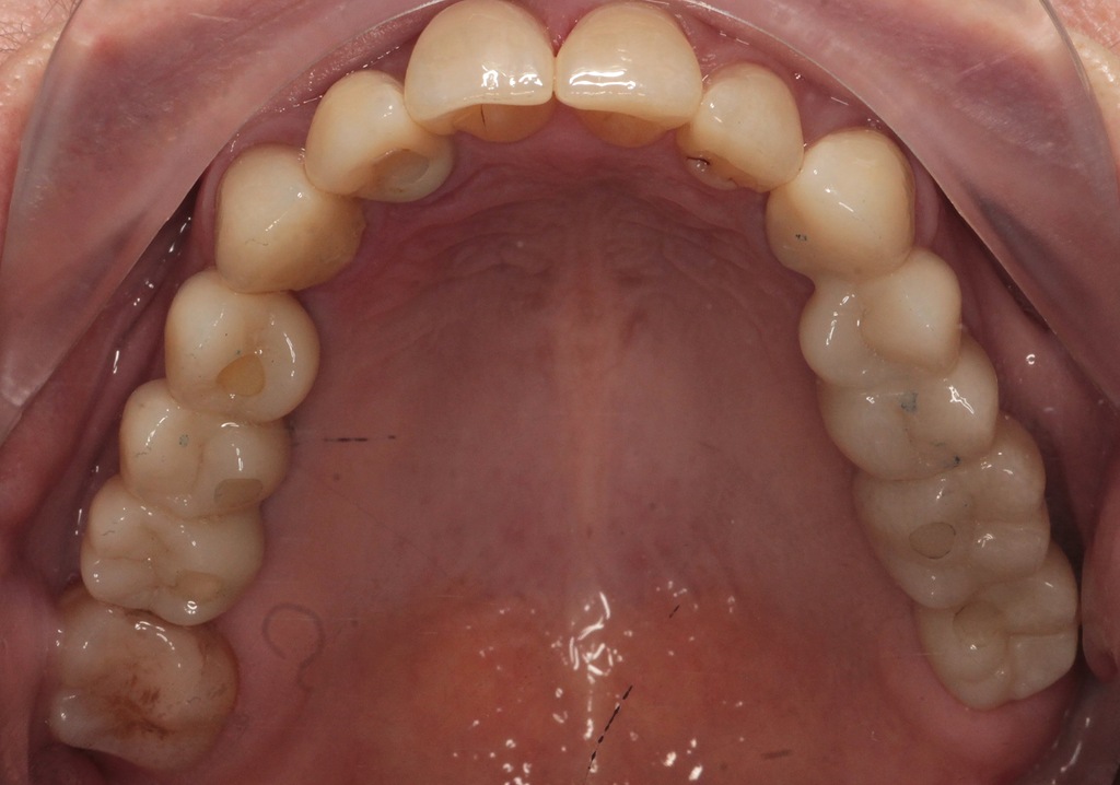 Имплантация и протезирование