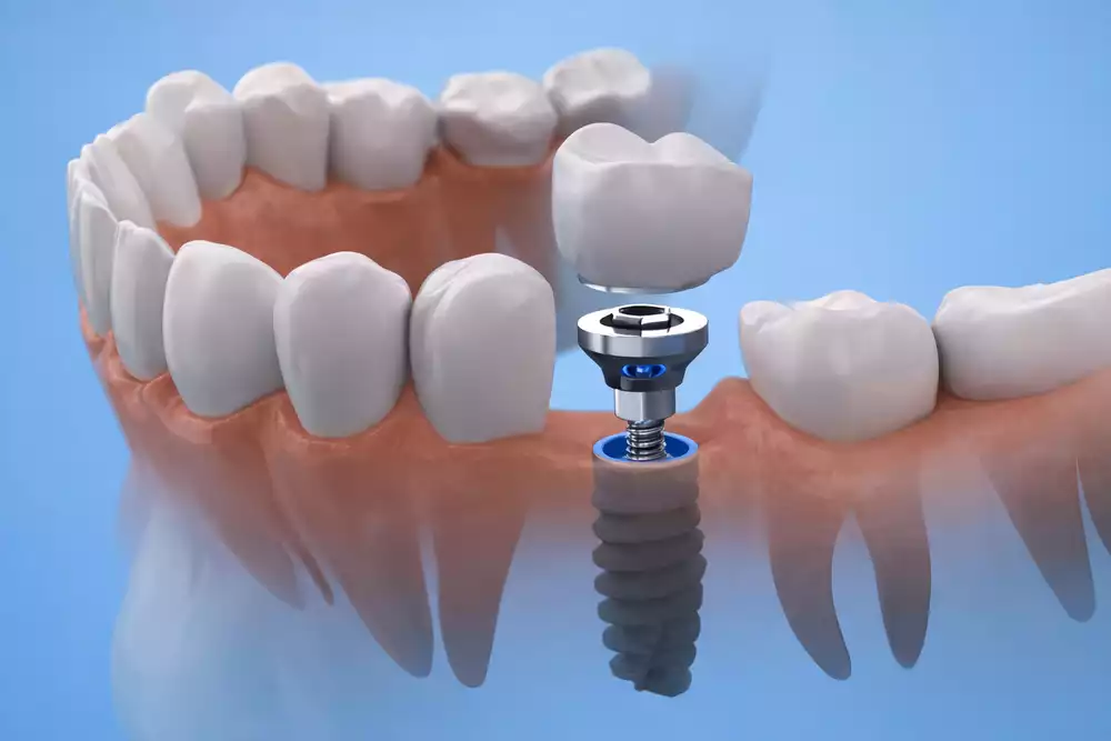 Коронки на имплантах