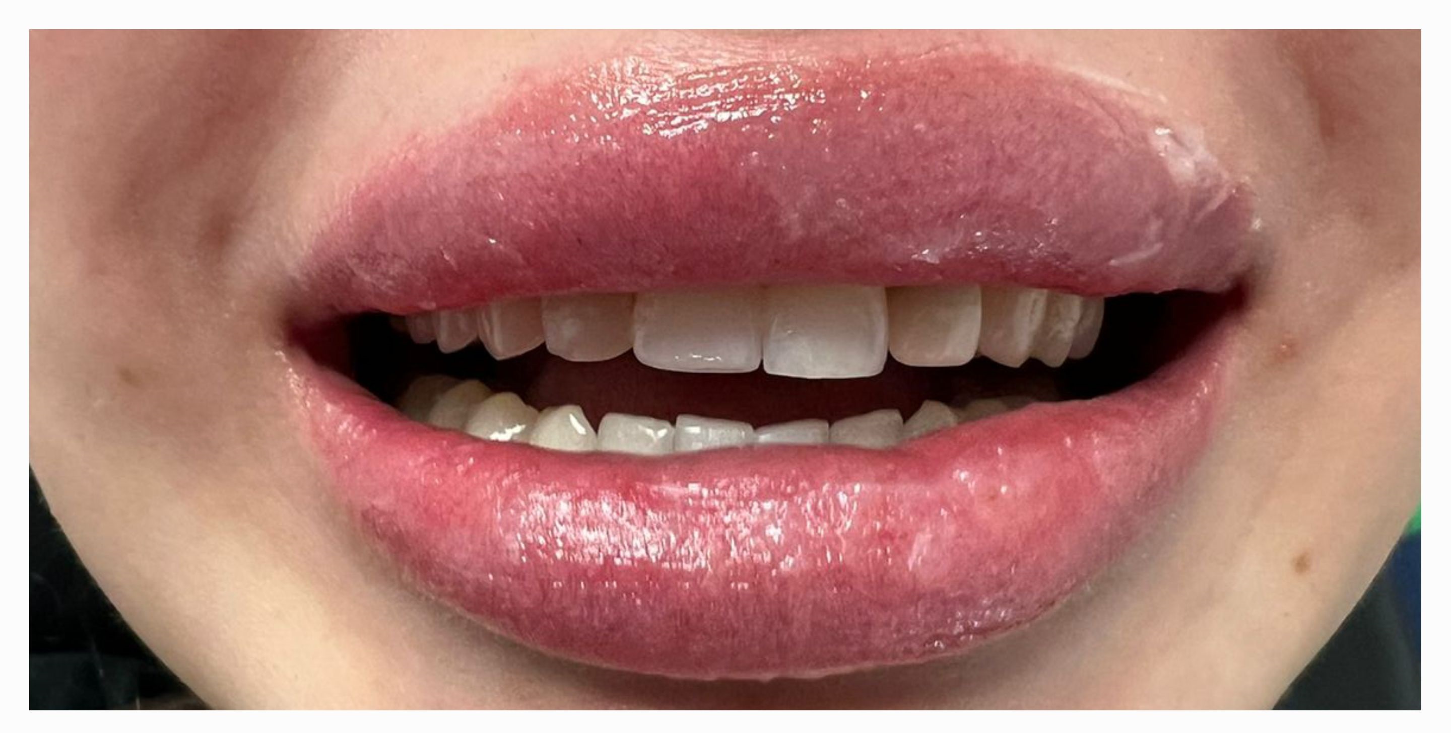 Композитные виниры