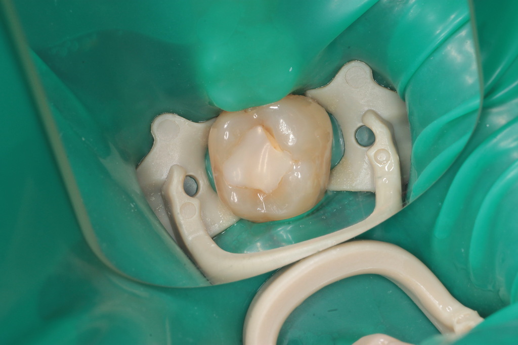 Лечение кариеса