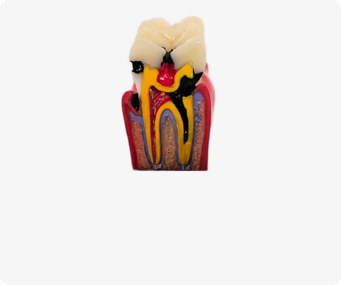 Лечение каналов зуба