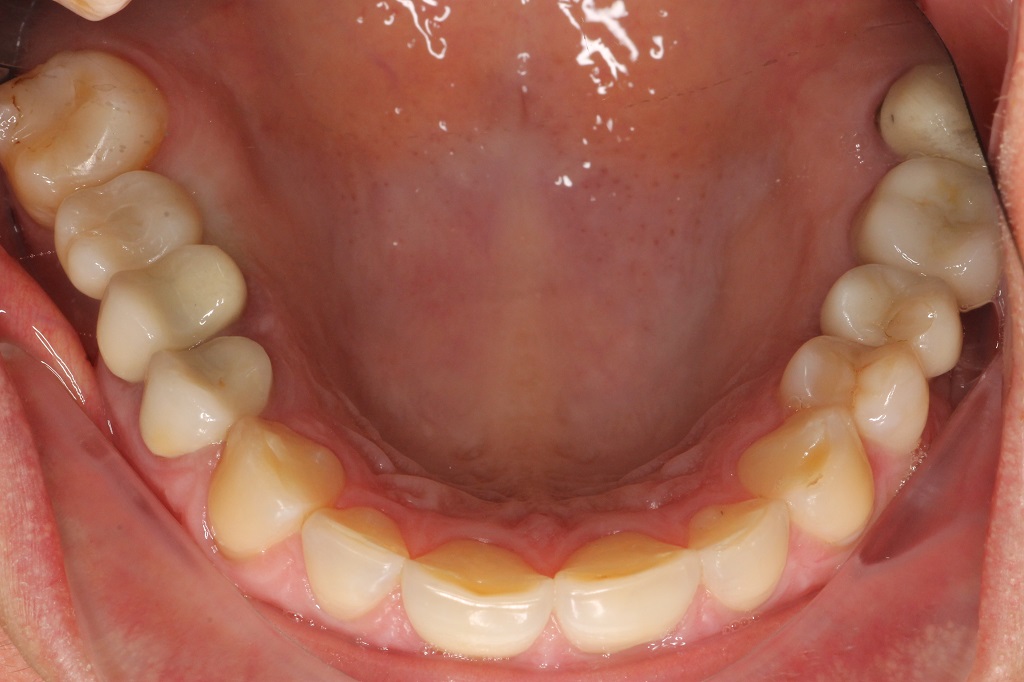 Установка имплантата