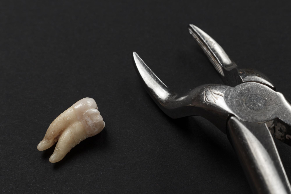 Зубы мудрости: удалять или нет?