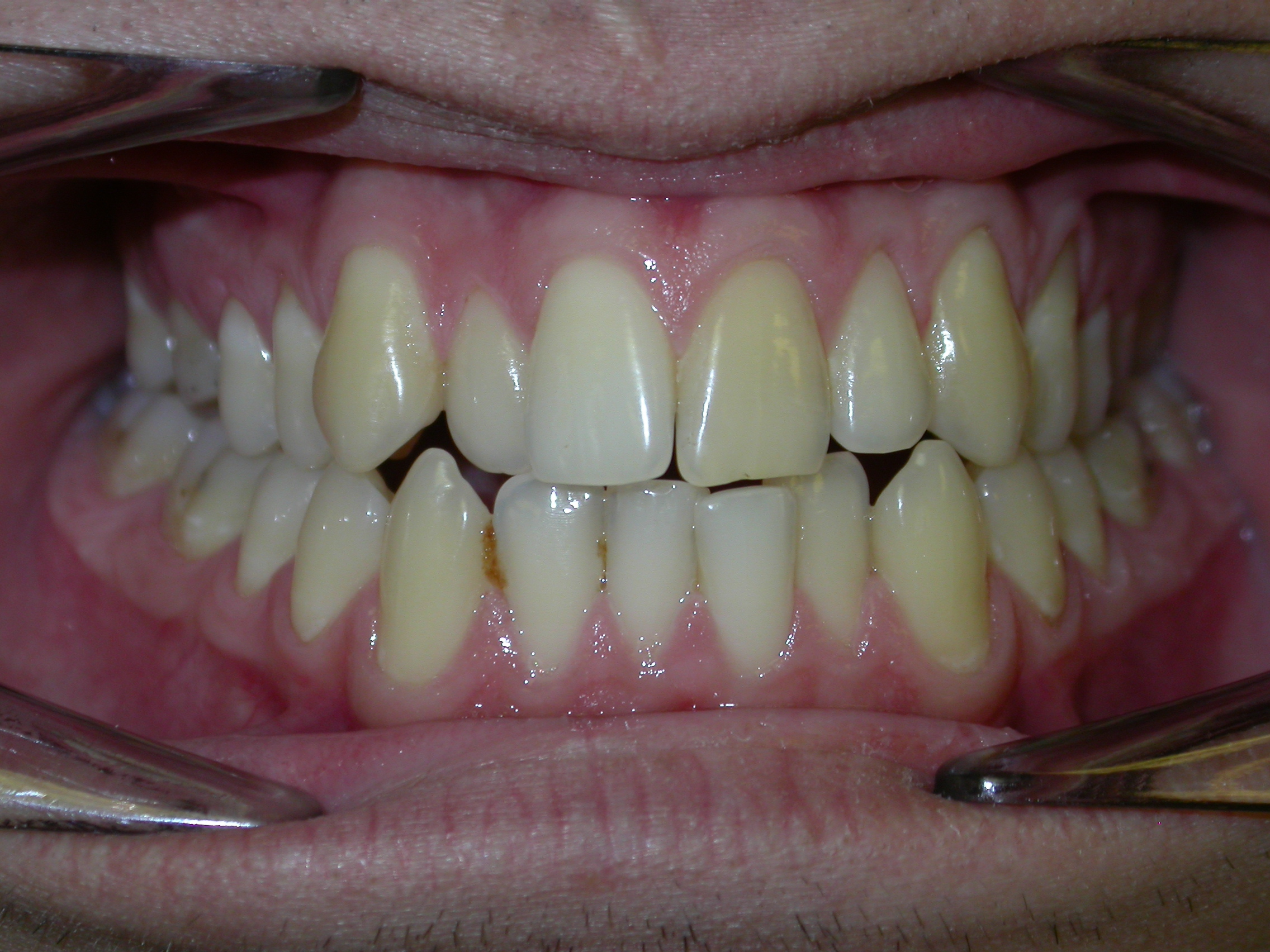 Исправление прикуса брекетами