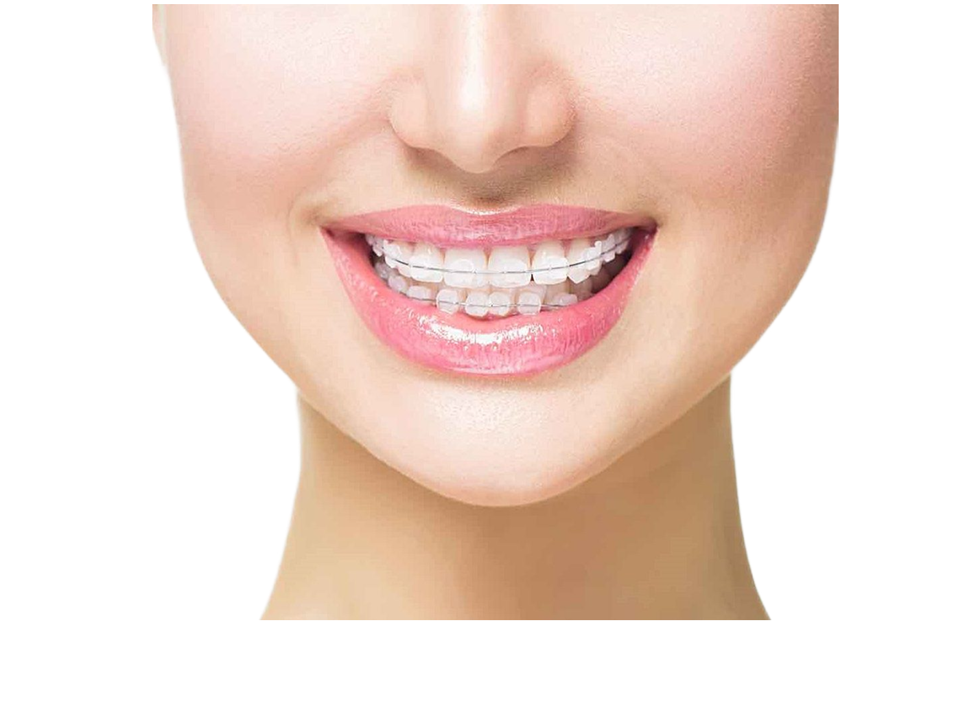 Сапфировые брекеты