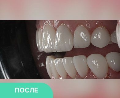 Виниры установка недорого - стоимость от 7500 руб. E-MAX - 25000 руб ...