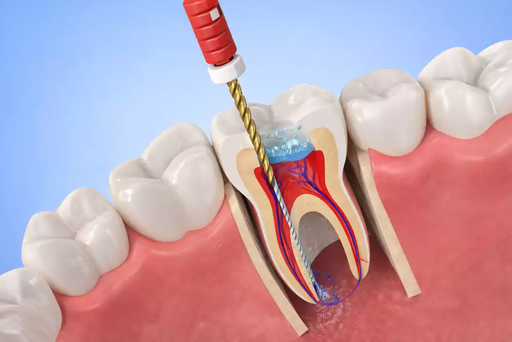 Болит зуб после лечения каналов: норма или ошибка врача