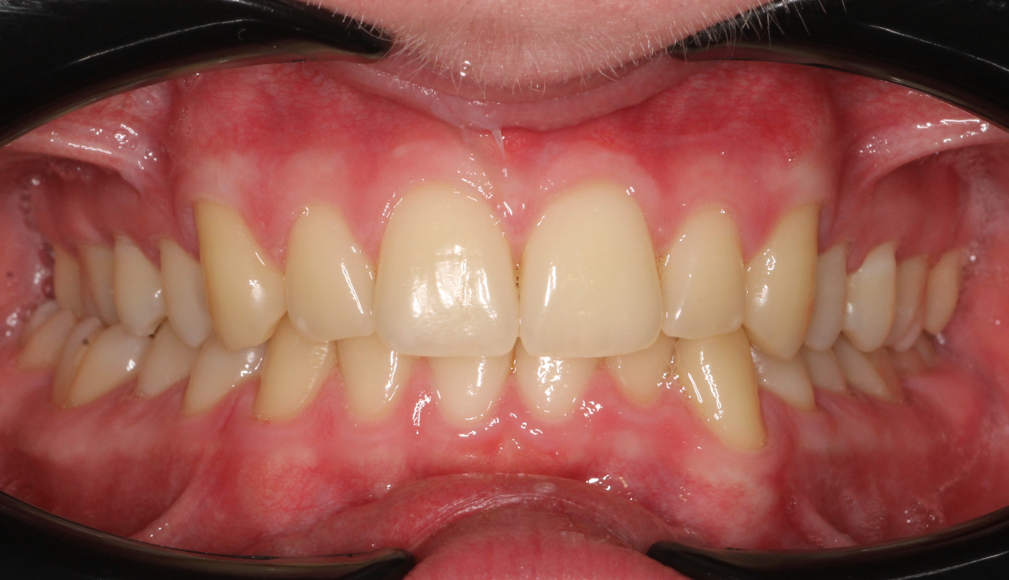 Исправление прикуса брекетами