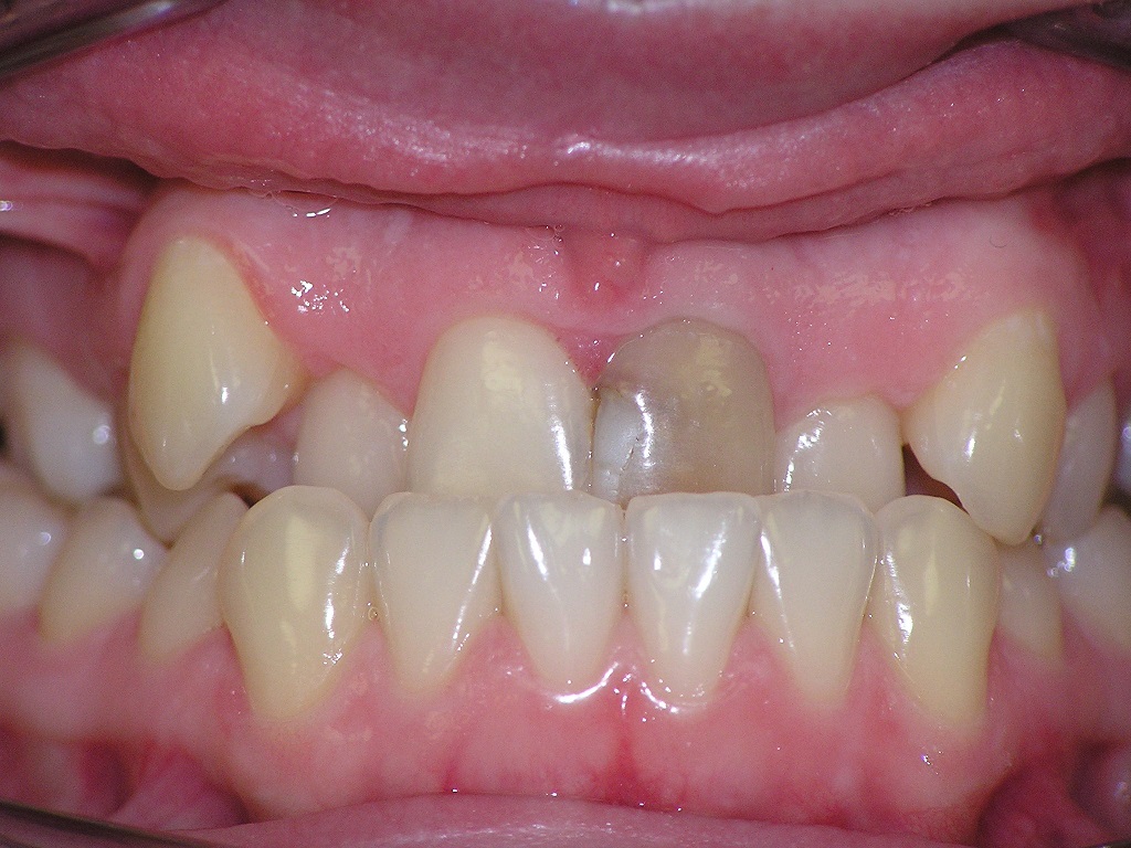 Исправление прикуса