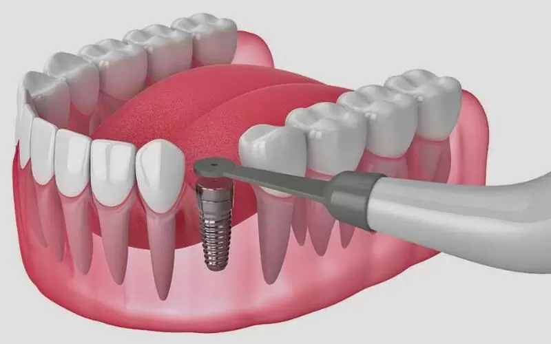 Как ставят импланты зубов