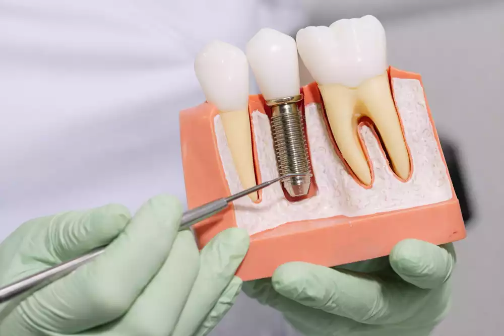 Виды зубных имплантов: какие лучше выбрать в 2026 году