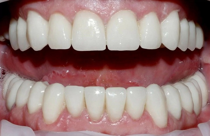 Циркониевые виниры