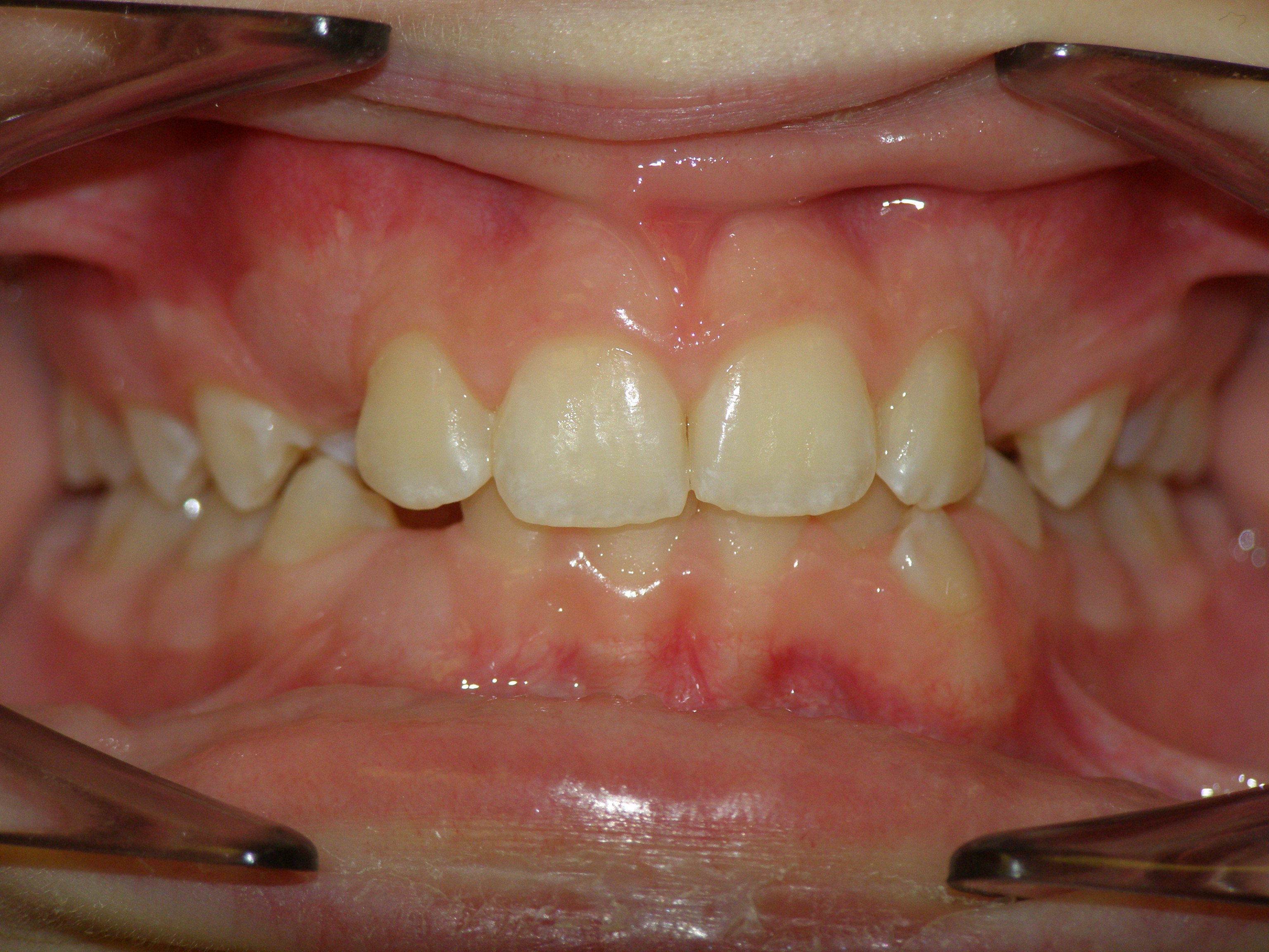 Исправление прикуса брекетами