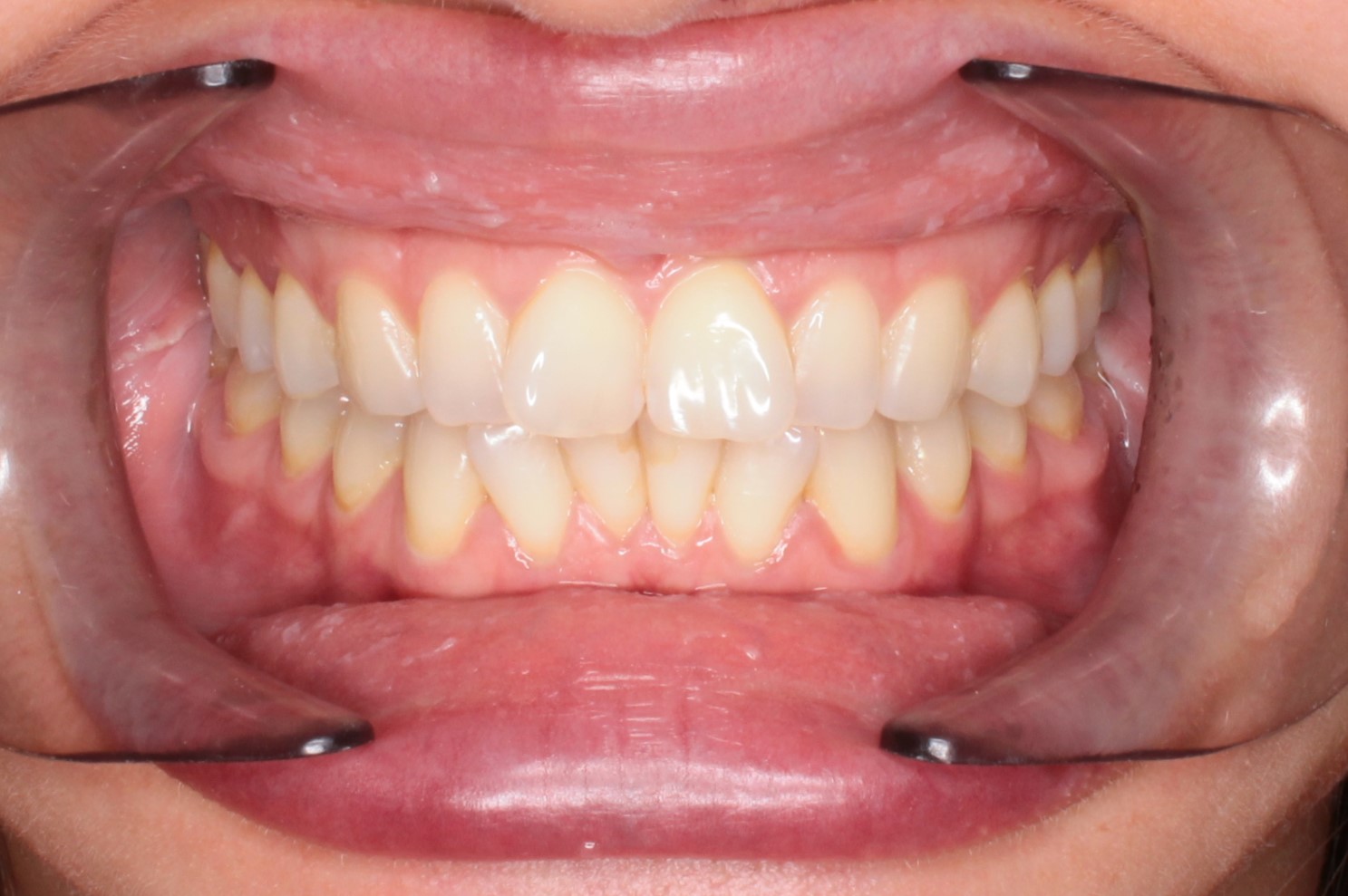 Исправление прикуса брекетами