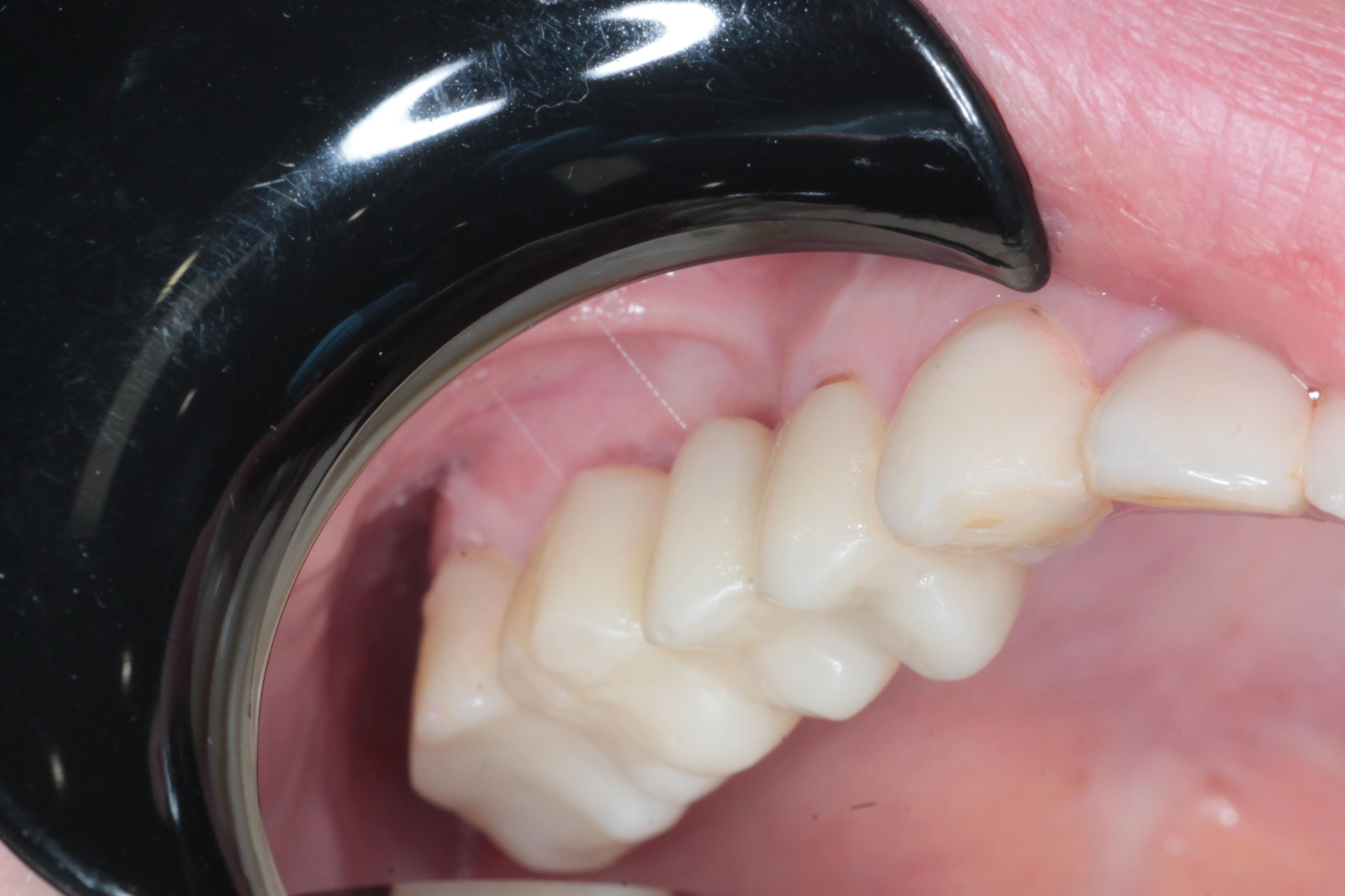 Десневая пластика в области имплантатов