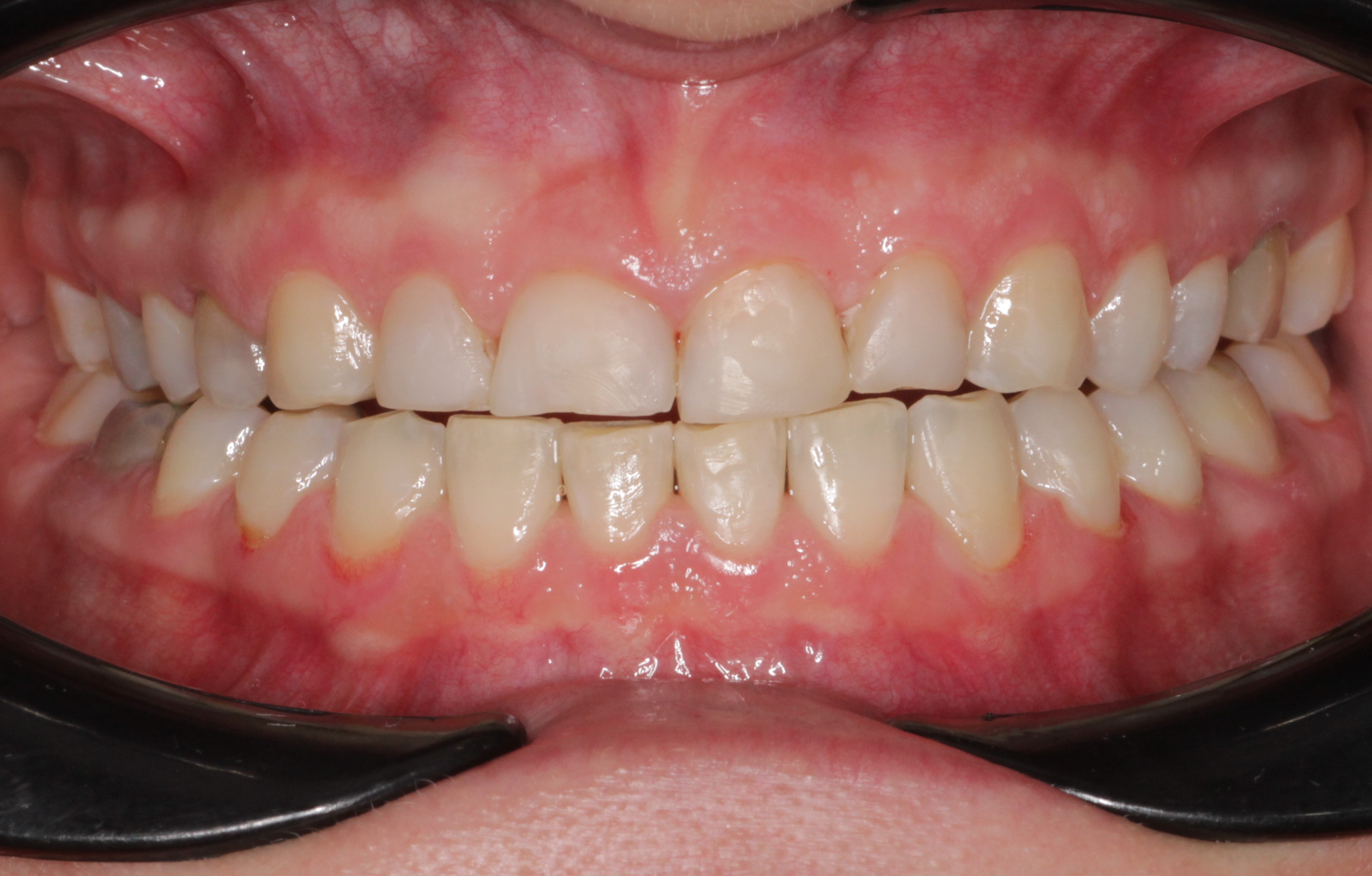 Исправление прикуса брекетами