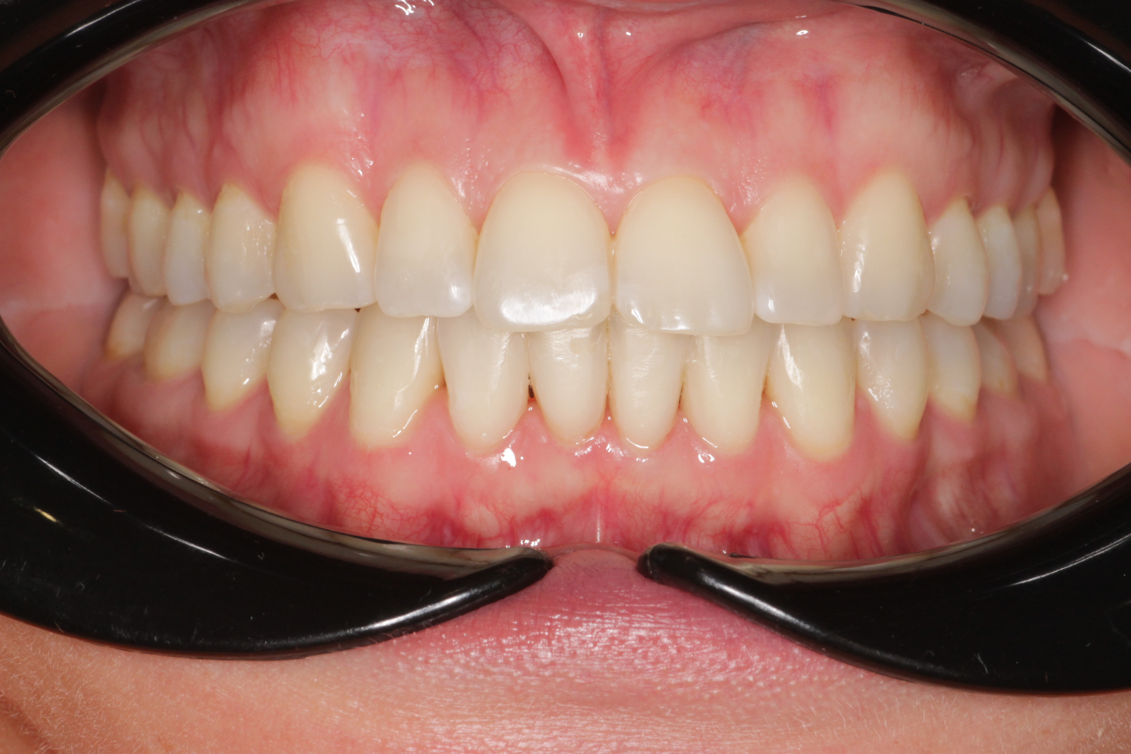 Исправление прикуса брекетами