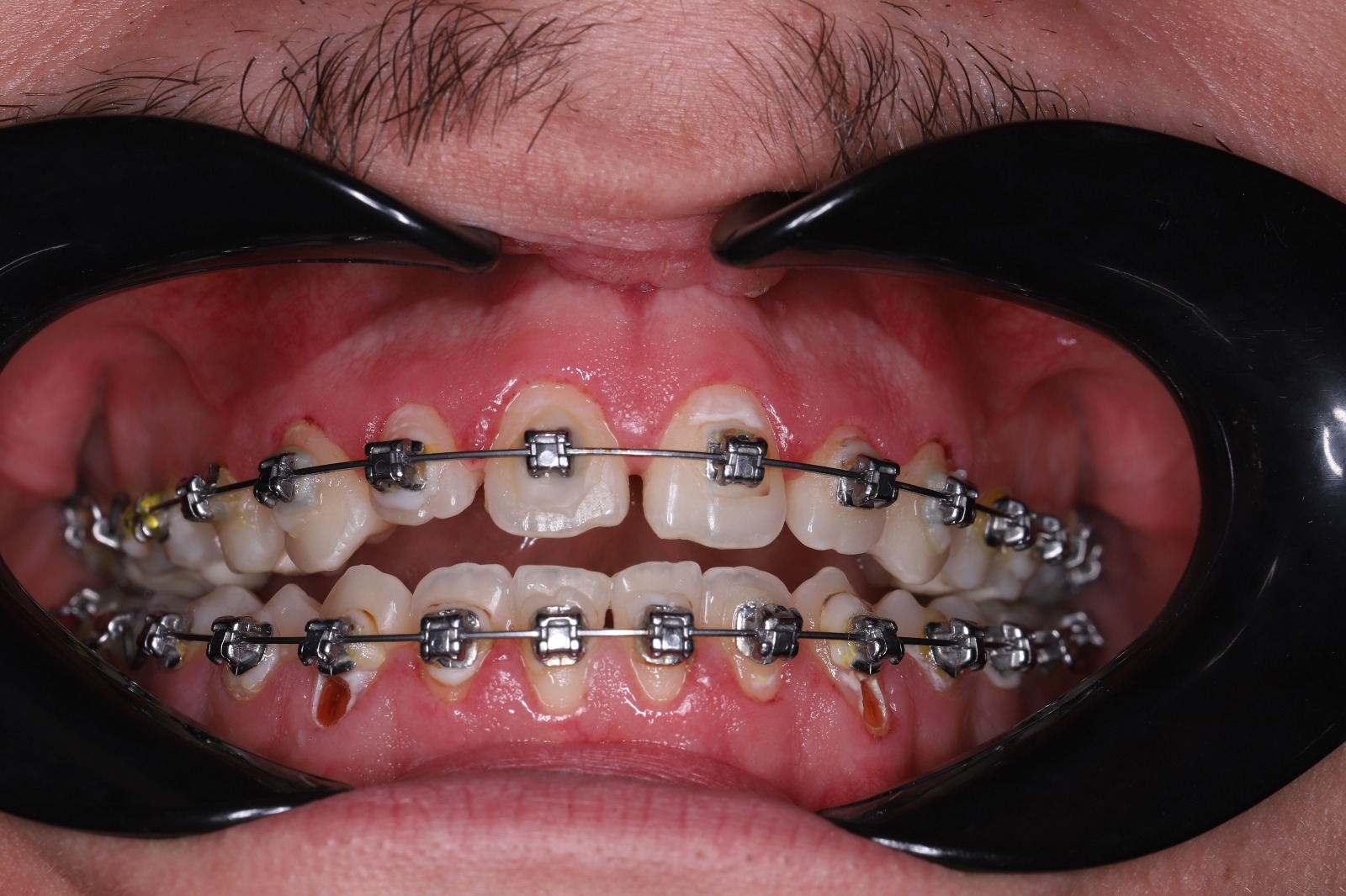 Лечение гингивита