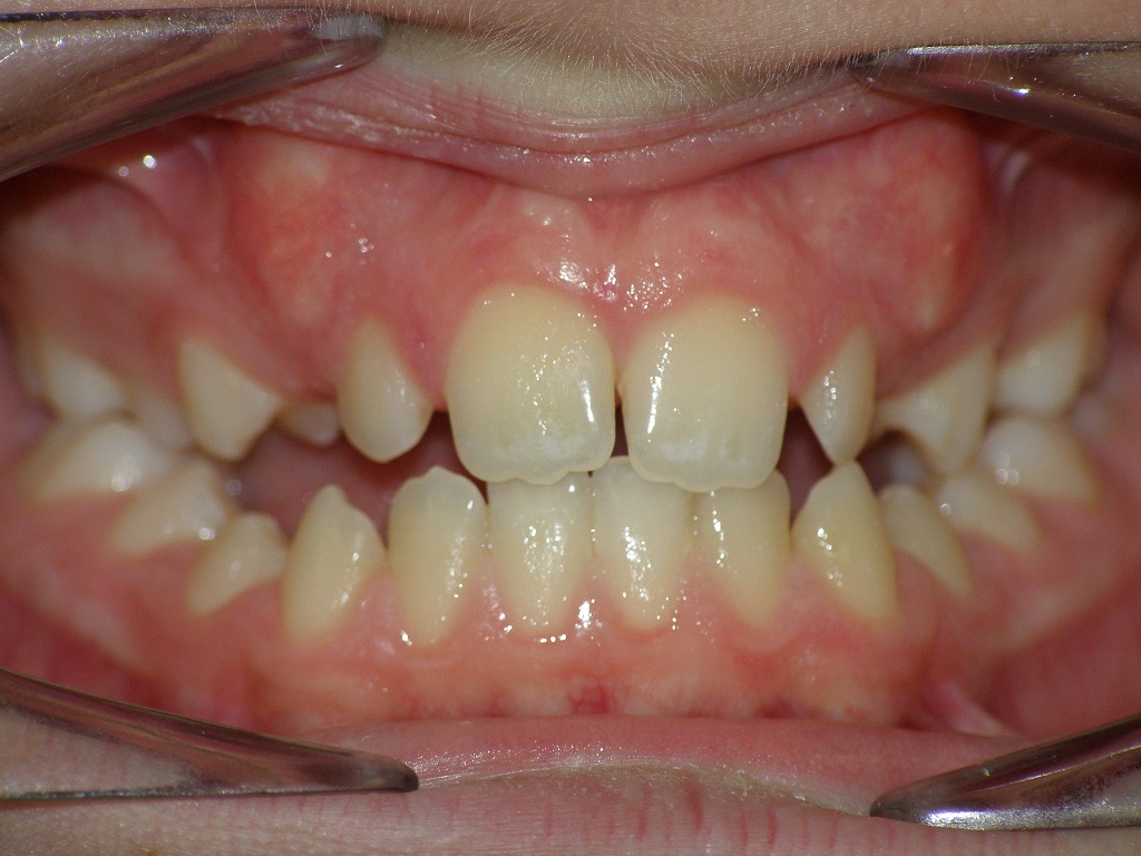 Исправление прикуса