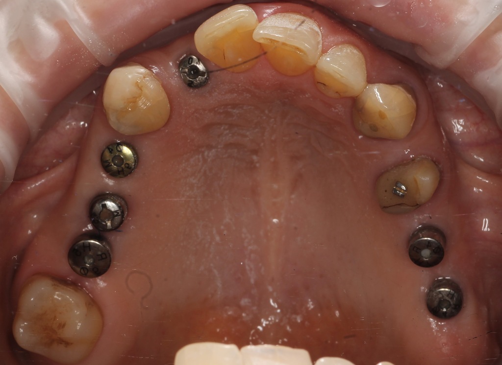 Имплантация и протезирование