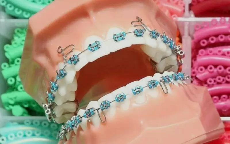 Больно ли ставить, носить и снимать брекеты