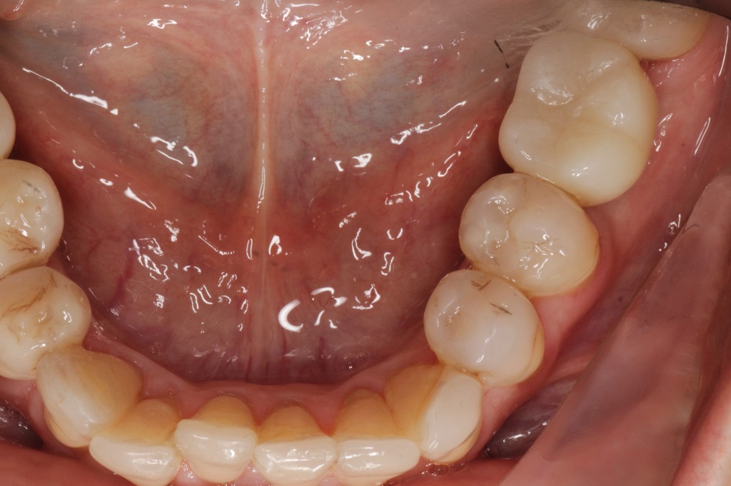 Установка имплантата