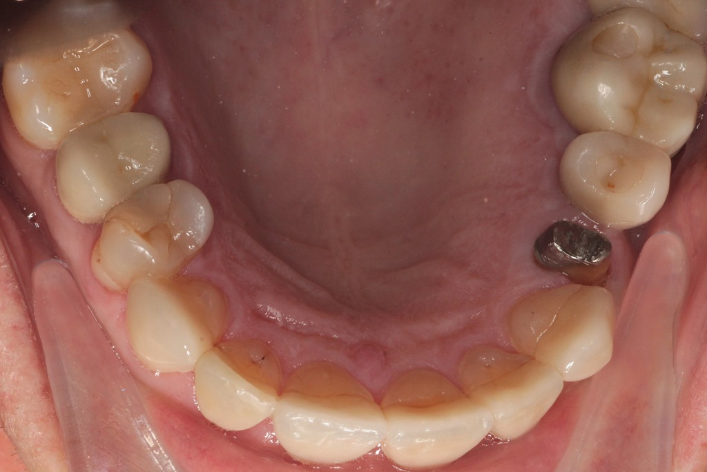 Металлокерамические коронки