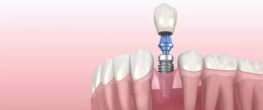 Одноэтапный протокол имплантации