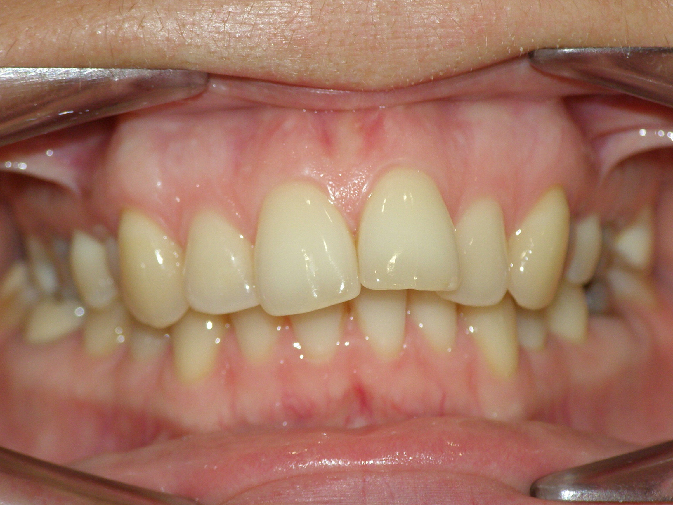 Исправление прикуса брекетами