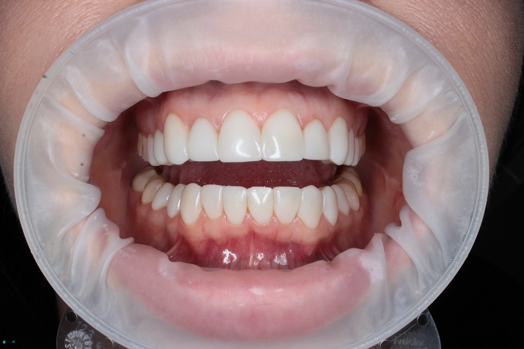 Керамические виниры